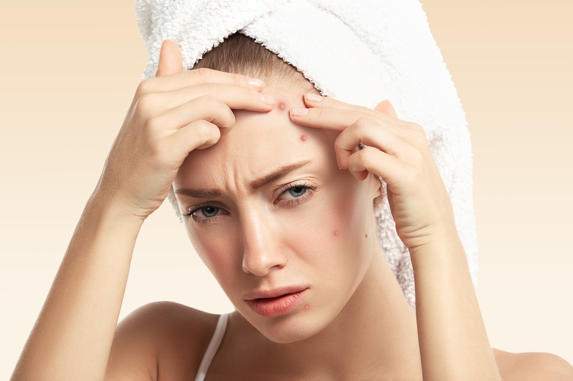 From Pimples to Acne Scars: Causes, Prevention & Remedies