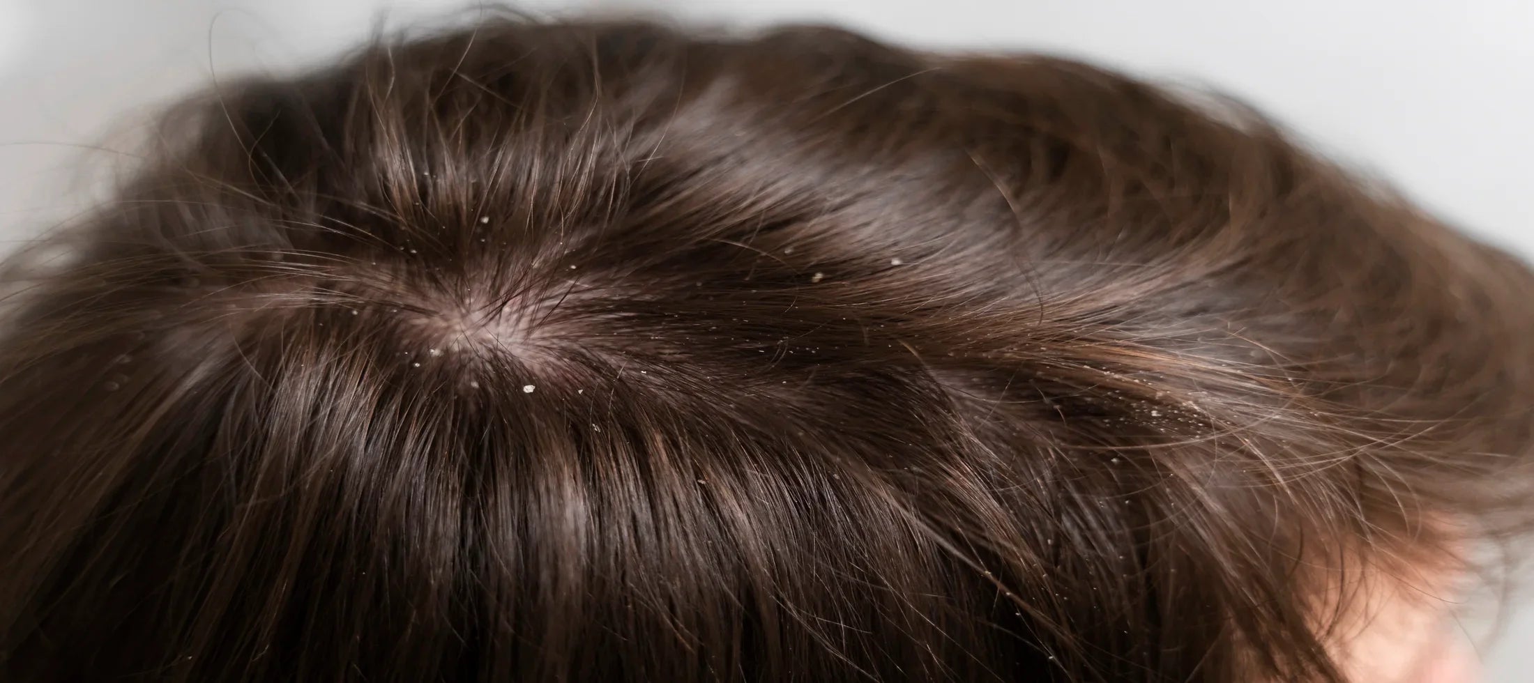 Dandruff and Dry Scalp